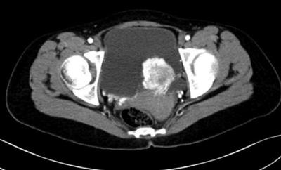 A retrospective study of paraganglioma of the urinary bladder and literature review